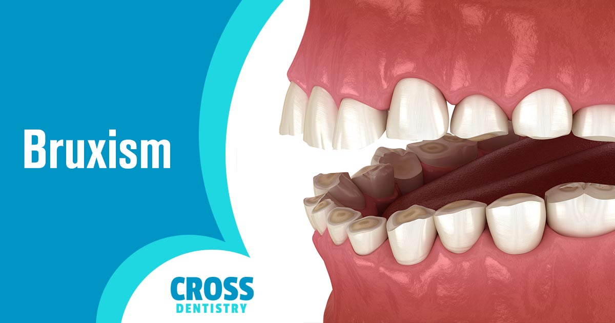 Image of teeth that appear to ground down from teeth grinding. Cross Dentistry - Do you suffer from jaw clenching, headaches, or teeth grinding? These symptoms can indicate a serious underlying dental issue - one that requires immediate attention.