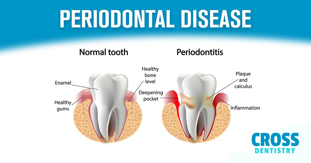 Image of a normal tooth and a tooth showing periodontitis. At Cross Dentistry, we're focused on providing patients with a comprehensive dental care. Periodontal diseases are mainly the result of infections and inflammation of the gums and bone that surround and support the teeth. In its early stage, called gingivitis, the gums can become swollen and red, and they may bleed.