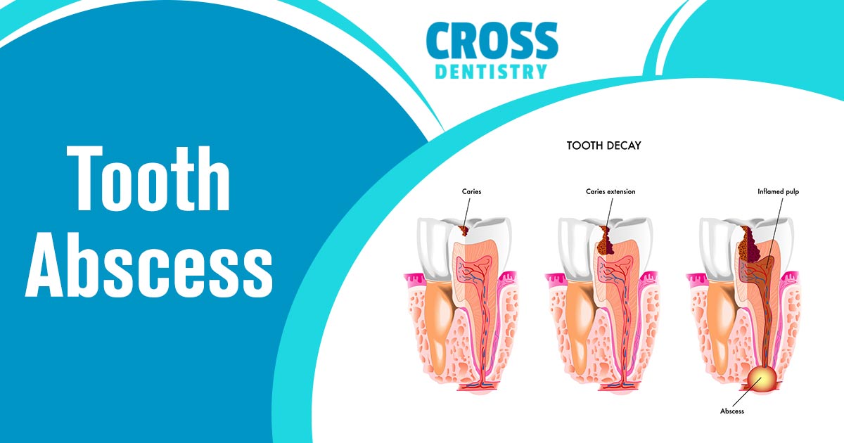 Image of illustration of teeth with cavity and one with tooth abscess. Cross Dentistry provides fast, reliable pain relief for your tooth abscess without the need for surgery. Our experienced professionals offer effective treatments that don't just mask your symptoms but target the root cause of your pain, giving you long-term relief so that you can get back to living life your way. Get fast and lasting tooth abscess pain relief with Cross Dentistry today!