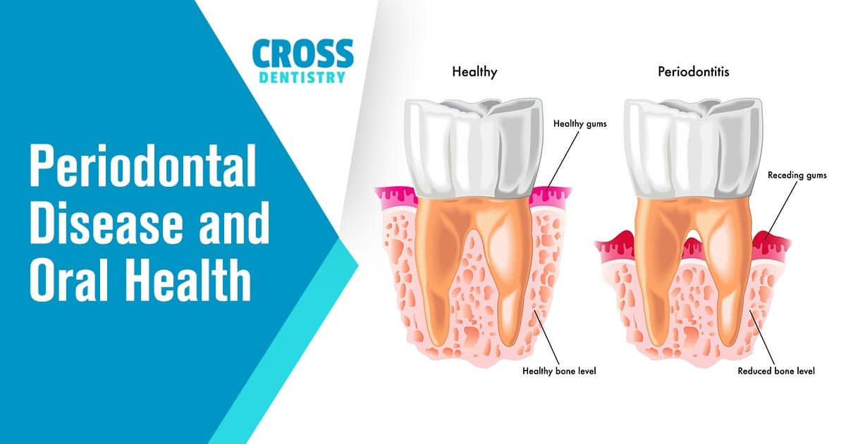 Cross Dentistry - A diagram of peridontal disease and oral health. Peridontal disease is a painful condition that can lead to tooth decay, infections, abscesses, and more if it's not treated in time. Left untreated, it can be very costly to correct all the damage done.